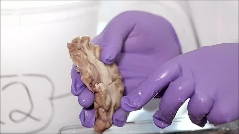 Cosa porta l'invecchiamento del cervello?