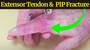 Expert Tips for Treating Extensor Tendon Laceration & PIP Fracture
