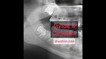 Black + White: Completely Impacted Lower Wisdom Tooth Removal Video