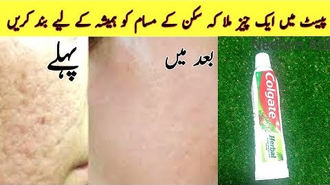 How To Get Rid Of Open Pores Naturally | How To Minimise Pore | In 15 Minutes Get Rid Of Open Pores