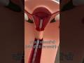 IUD insert#shortvideo#explore#copper t short video#