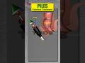 Worried About Piles Surgery? Choose a Bloodless, Painless Alternative