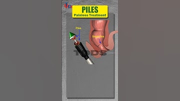 Worried About Piles Surgery? Choose a Bloodless, Painless Alternative