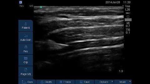 Transversus Abdominis Plane TAP Block