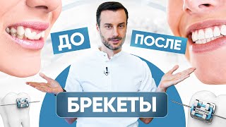 Брекеты - До и После. Как сильно ровные зубы меняют внешность?