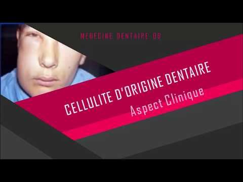 Vidéo: Qu'est-ce qu'une infection actinomycosique ?