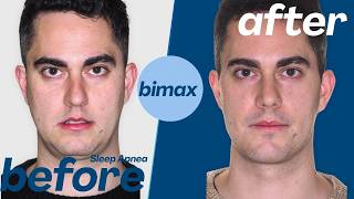Sleep Apnea Before & After | Bimaxillary Surgery Transformation | Real Case