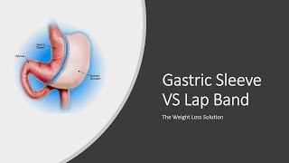 Gastric Sleeve VS Lap Band - The Weight Loss Solution