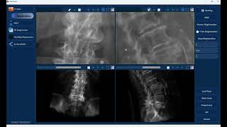 2D-3D Registration from CT to X-ray/Fluoro images In Spine Surgery