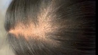 How to mask thinning or balding in your crown