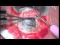 Vido n 2 du centre du glaucome sclrectomie profonde non perforante spnp dr ezzouhairi