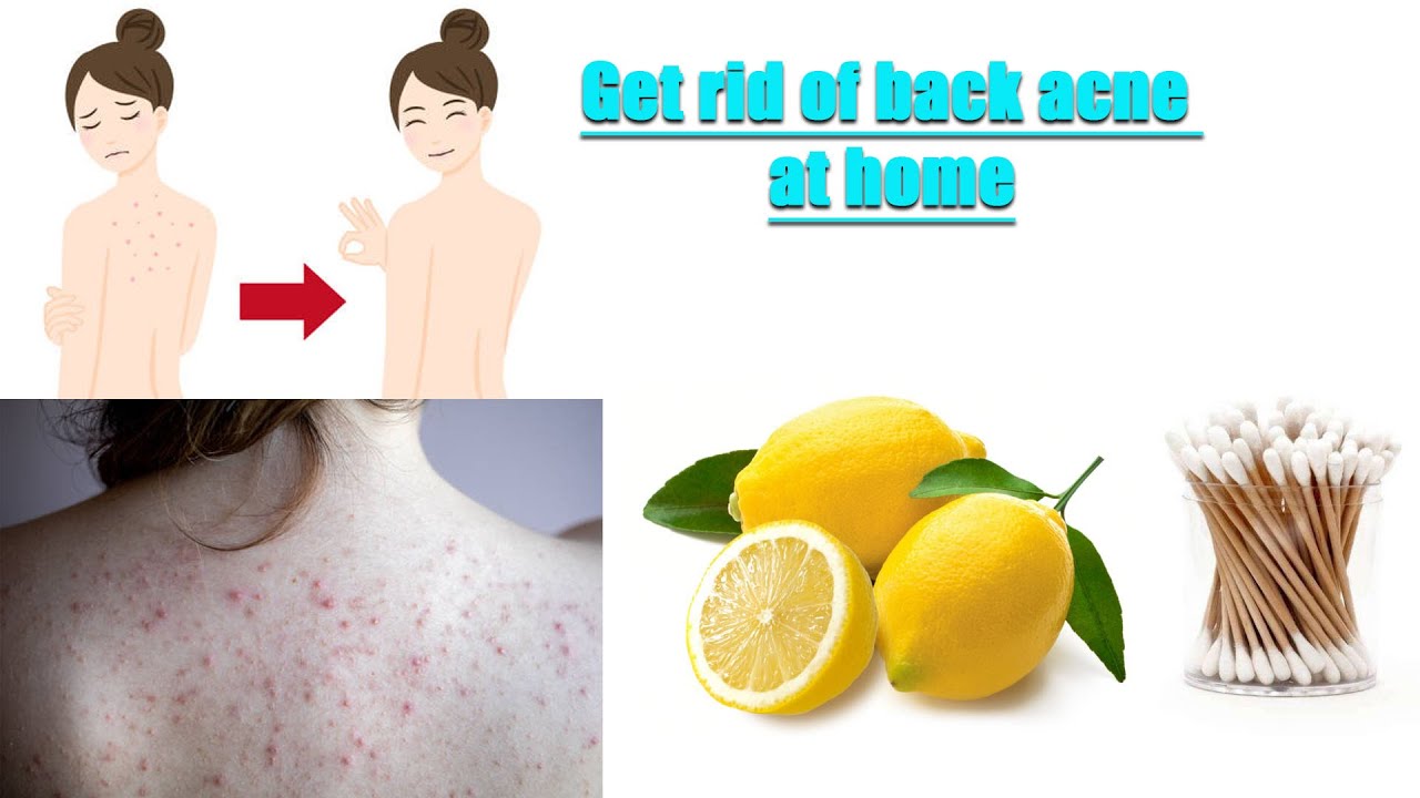 How to get rid of back acnes SRtrue TV YouTube