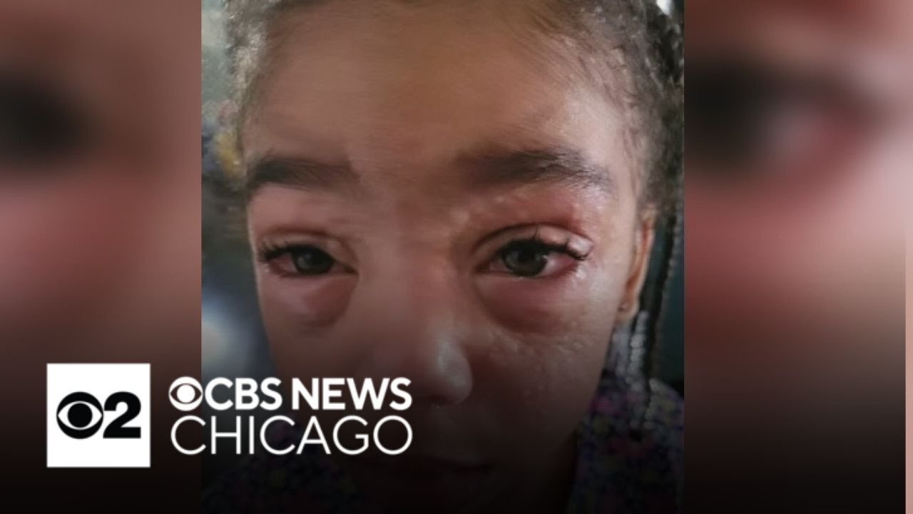 Chicago hospital hopes a patch could help kids who suffer from peanut allergies