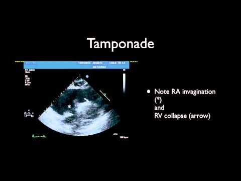 Tamponade & Pericardiocentesis