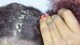 ITCHY DRY SCALP | SCRATCHING DANDRUFF