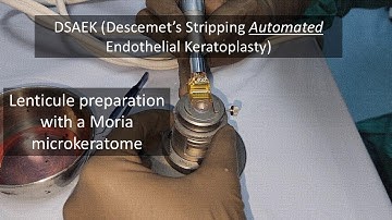 DSAEK lenticule preparation with Moria Microkeratome