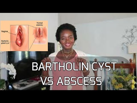 *HEALTH ISSUE* BARTHOLIN CYST VS ABSCESS. UNDERSTANDING THE MEANING, CAUSES AND TREATMENTS. CHINWE