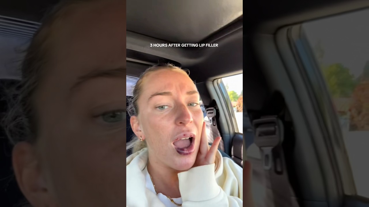 HOW TO PREVENT LIP FILLER BRUISING