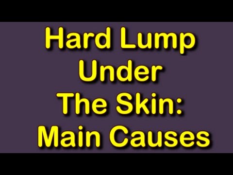 Video: Lump Hard Under Skin: 8 Cauze și Modul în Care Sunt Tratate