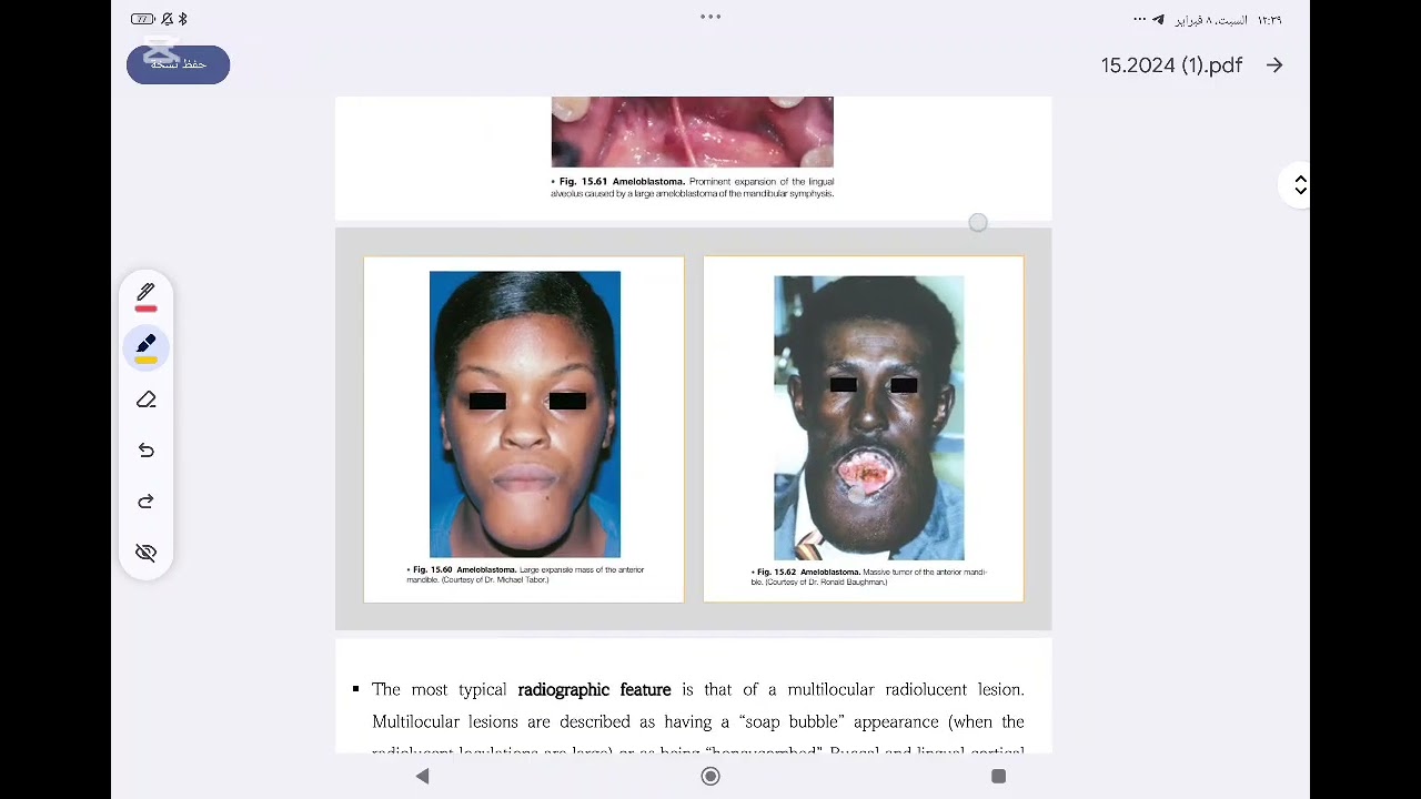 oral pathology odontogenic tumor part 1 مرحلة رابعة طب أسنان