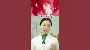 Răng khôn mọc lợi trùm | Nha Khoa Thuỳ Anh #shorts