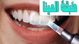 طبقة المينا تآكل وترميم مينا الأسنان | علاج تاكل طبقة المينا