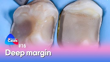 Deep margin | BG Dental Cases №16