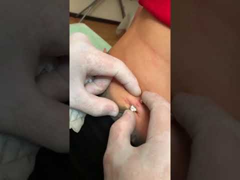 Вопрос: Как чистить пирсинг пупка?