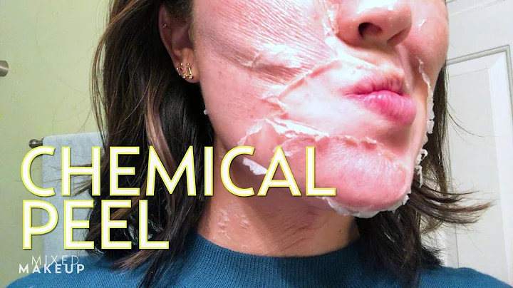 We Tried the Perfect Derma Chemical Peel! | The SA...