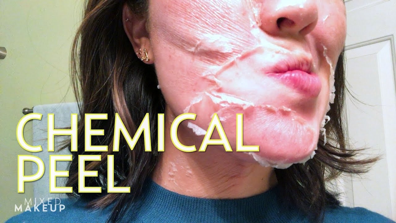 We Tried It: A Chemical Peel Without the Pain andPeeling picture foto We Tried It: A Chemical Peel Without the Pain andPeeling