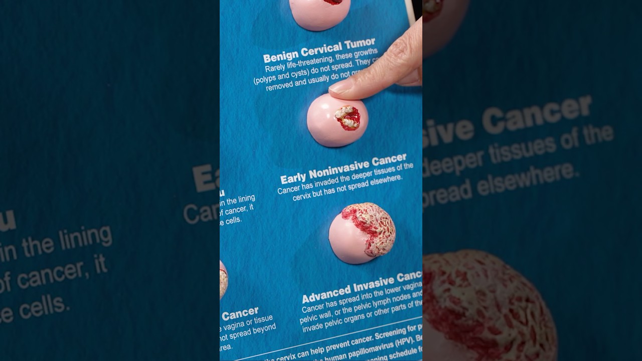 Stages of cervical cancer - From benign to advanced | UC Davis Health Tips