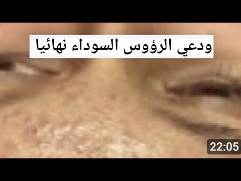شوف النتيجة قبل وبعد إزالة الرؤوس السوداء مش حتصدق