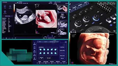 Ecógrafo Alpinion ECUBE 11   3D4D  Tutorial