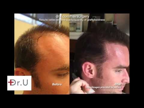 Hair Transplant Patient S 12 Month Update 4500 Ugrafts Of Beard Hair Transplant Patient S 12 Month Update 4500 Ugrafts Of Beard And Head