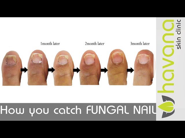 Expert Nail Fungus Treatment - Torbay Footcare