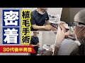 植毛手術の1日に密着!30代後半男性