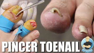 PAINFUL PINCER TOENAIL REMOVAL