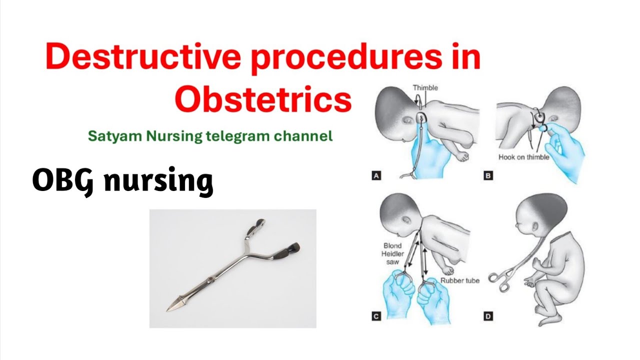 Destructive procedures in obstetrics | define destructive operations ...
