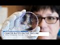 Rate of cancer deaths decreasing while rate of diagnoses increases