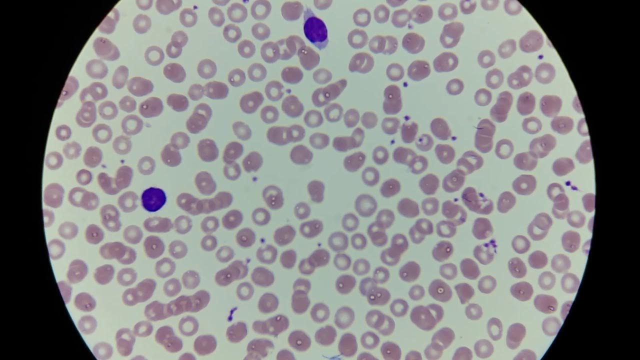 5 лейкоцитоз. Лейкоцитоз фото. Лейкоцитоз под микроскопом. Ключевая клетка в гинекологическом мазке.