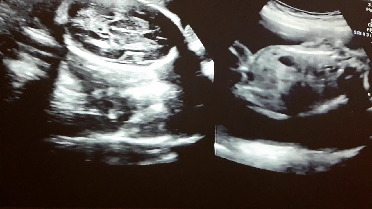 Ultrassom 3D morfológica 23 semanas - YouTube