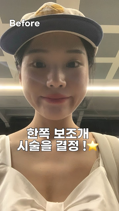 보조개 시술 후기🍓 #보조개 #쁘띠시술