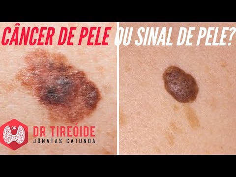 Vídeo: Toupeira No Couro Cabeludo: Tipos De Toupeiras, Riscos E Sinais De Alerta De Melanoma