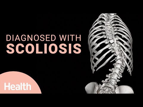 What is Scoliosis? Effects of a Scoliosis Diagnosis & Life After Spinal Fusion Surgery | Deep Dives