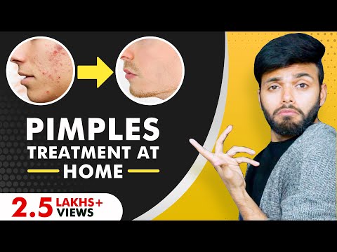 Scientific Acne Treatment at Home  | How to Remove Acne Pimples from Face