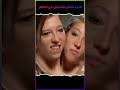 أغرب توائم ملتصقين في العالم 