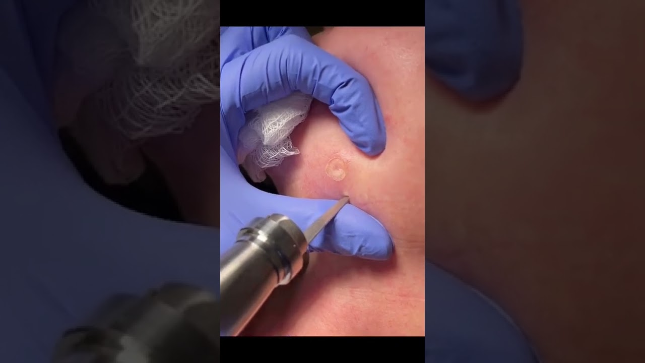 Dermal Nevus removal #shorts