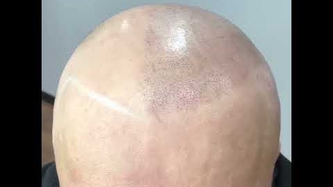 First Session ScalpMicropigmentation (Must See)