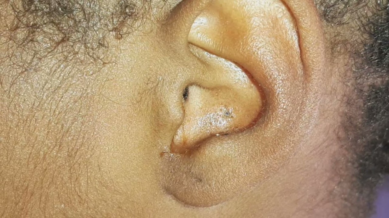 ASRM EAR CLEANING YouTube