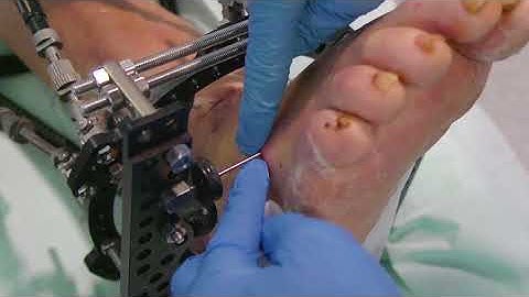 Patient guide: pin site care